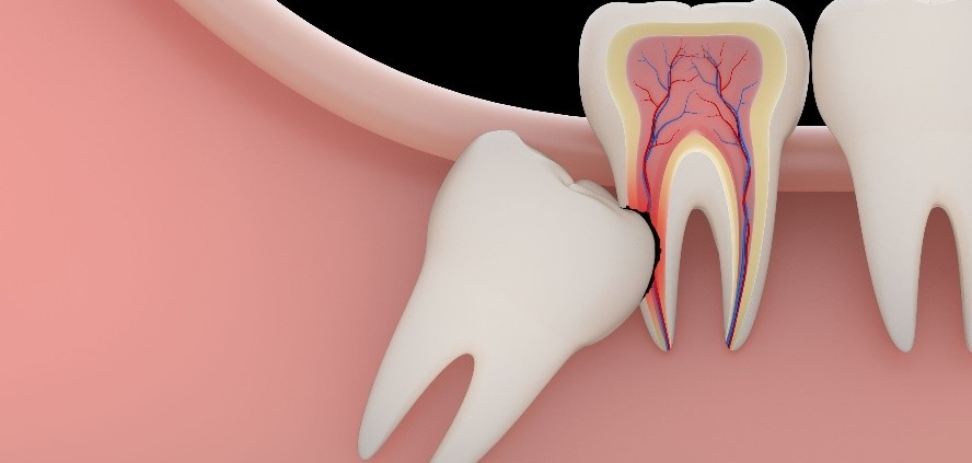 انواع علت تشخیص عوارض و درمان دندان نهفته