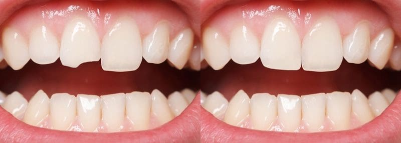 انواع باندینگ دندان مزایا و معایب درمان و مراقبت