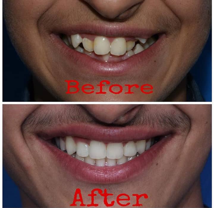 نمونه کار ارتودنسی در کلینیک دندانپزشکی بهاران