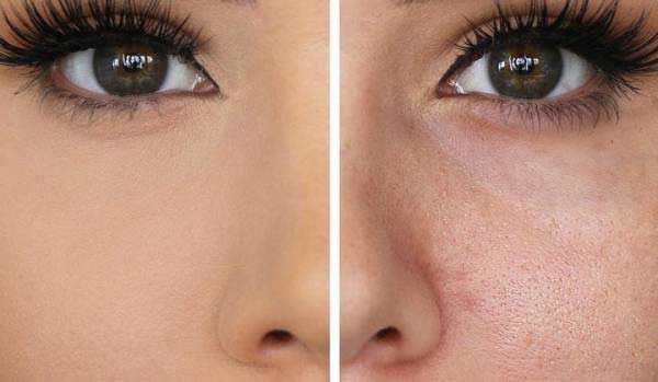 میکرونیدلینگ روشی برای درمان منافذ باز پوست