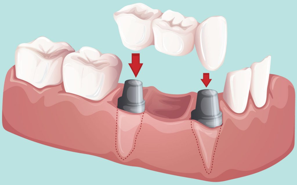 انواع بریج دندان مزایا معایب مواد سازنده و هزینه آن