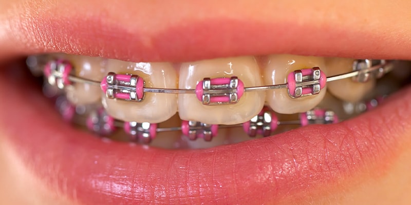 آشنایی با درمان ارتودنسی دندان