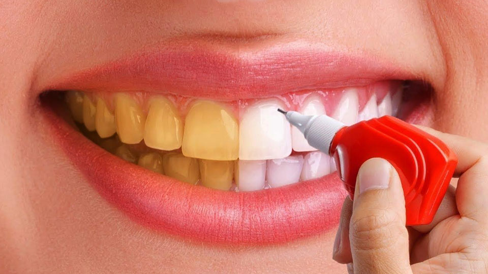 مزایای بلیچینگ دندان 