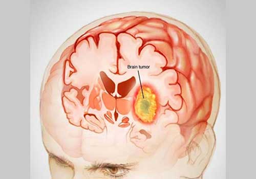 تومور مغزی ؛ علائم خاموش و نشانه های اولیه
