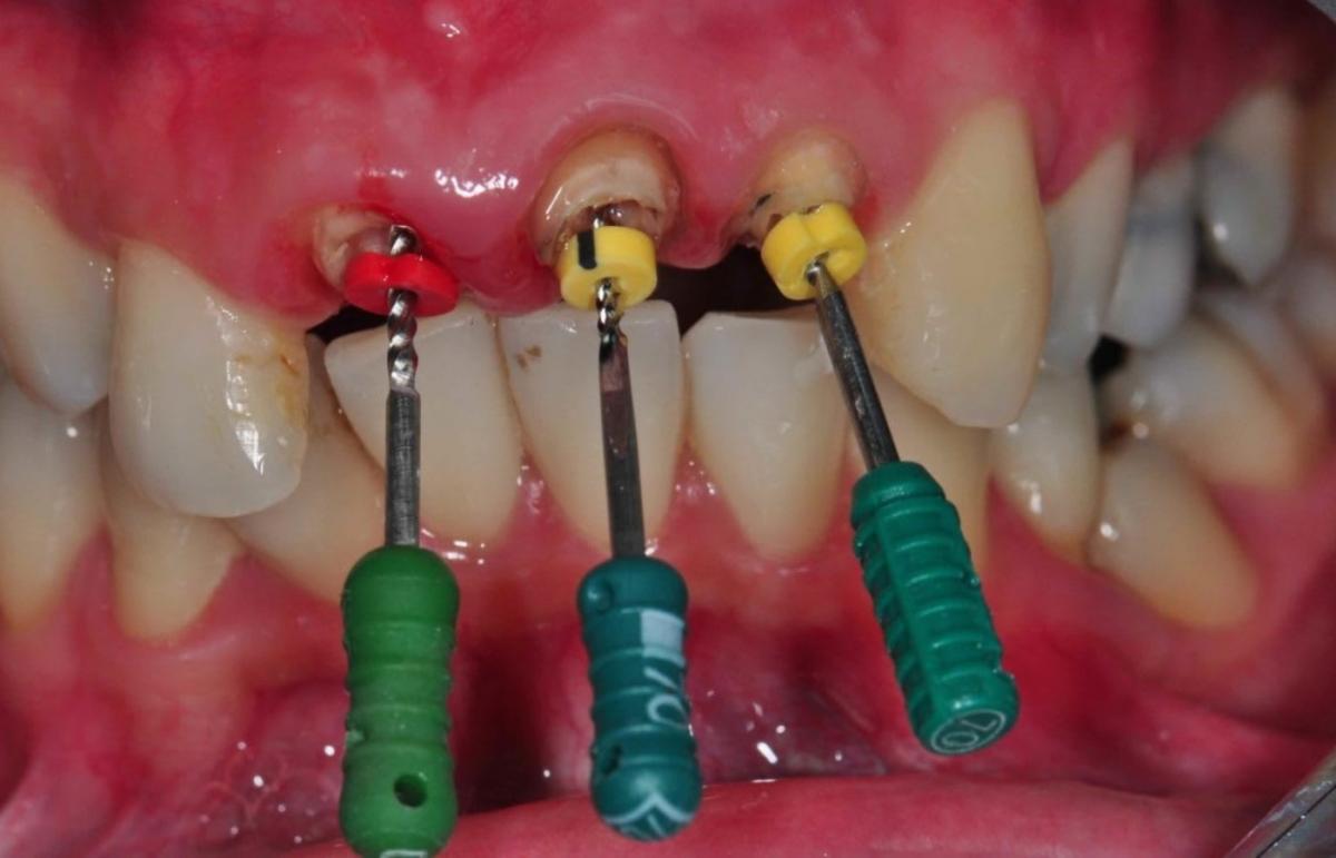 مراحل عوارض هزینه و زمان مناسب عصب کشی دندان