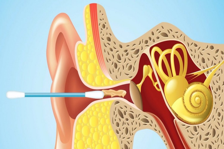 بیماری منییر گوش علائم تشخیص و درمان