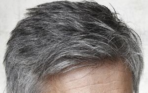 کاشت مو به روش ترکیبی چیست ؟