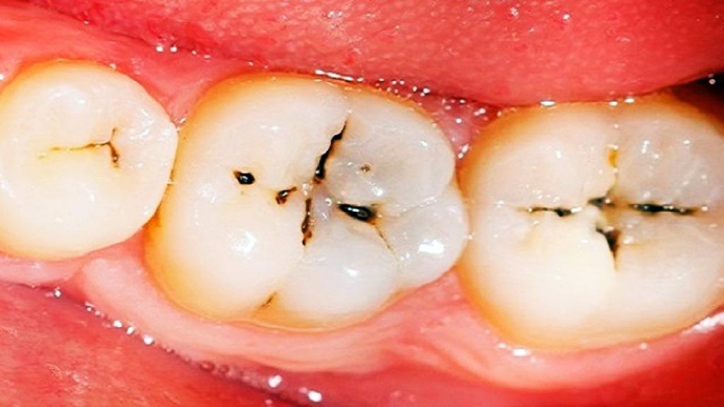 شایع ترین بیماری های دهان و دندان