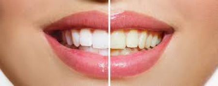 زردی دندان ها نشانه چیست ؟