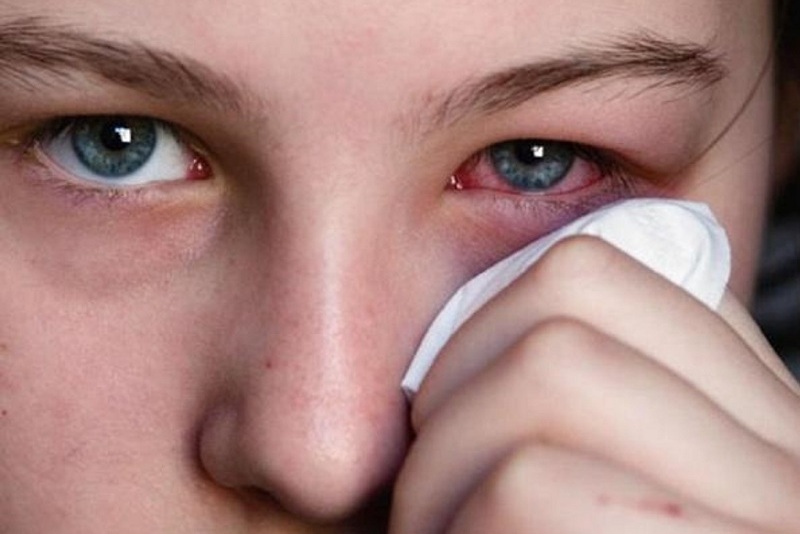 درمان های خانگی برای عفونت چشم