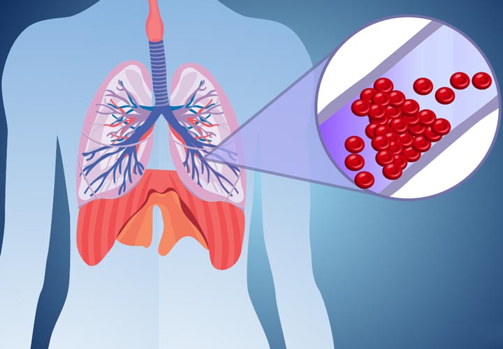 آمبولی ریه چیست از علائم تا تشخیص و درمان