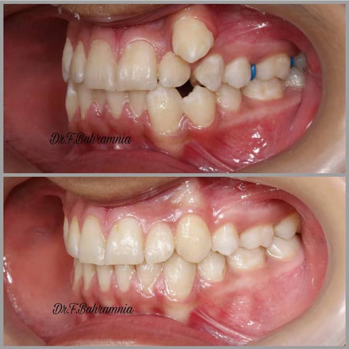 نمونه کار ارتودنسی در کلینیک دندانپزشکی بهاران