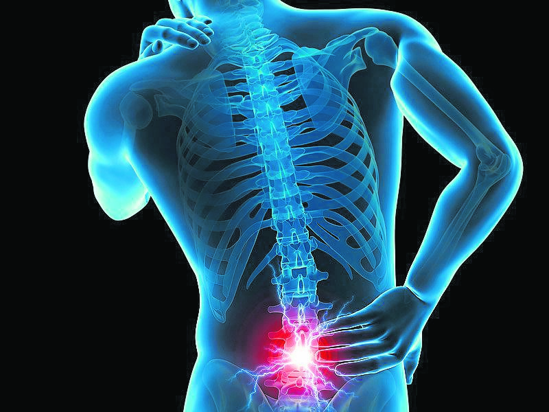 پارگی دیسک کمر ،علل ، علائم ، تشخیص و درمان