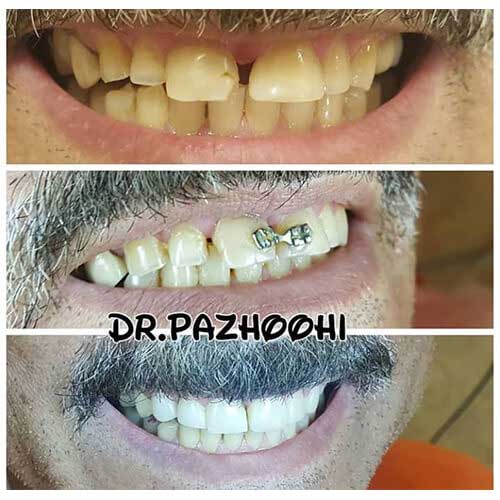 نمونه کار زیبایی و فیسینگ دندان در کلینیک دندانپزشکی بهاران