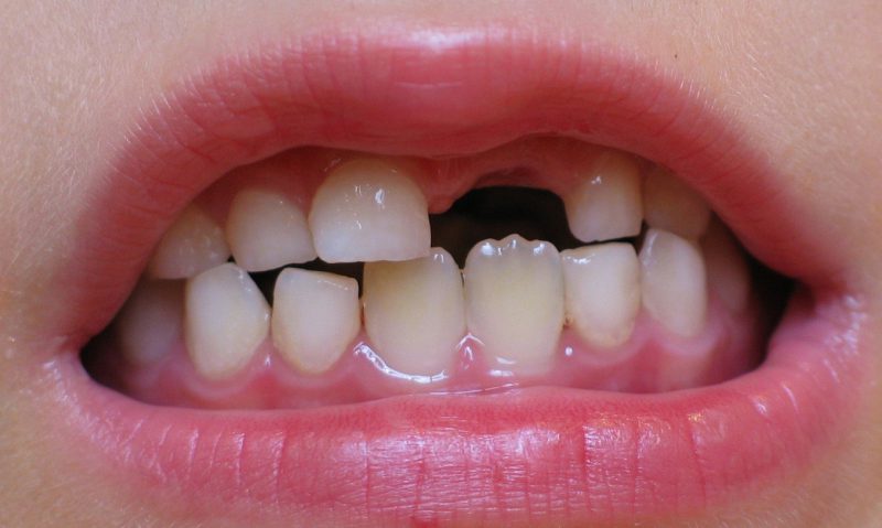 ترمیم دندان های شیری زمان روش و مراقبت