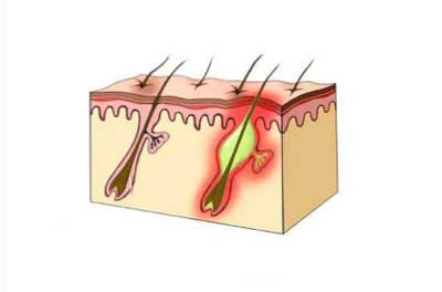 فولیکولیت ؛ التهاب یا عفونت فولیکول مو چیست؟