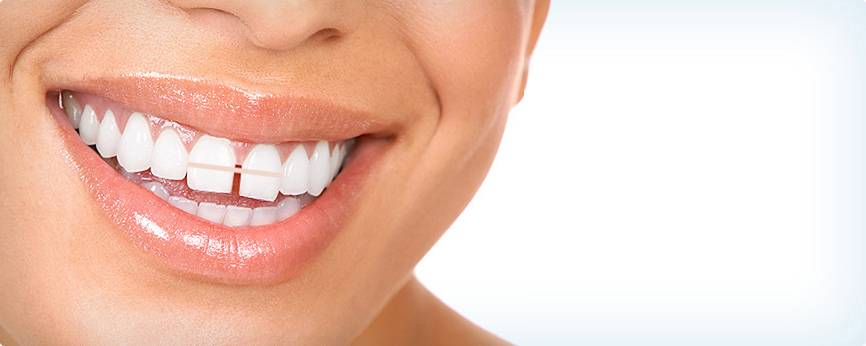 انواع روش بستن فاصله میان دندان ها و سوالات متداول