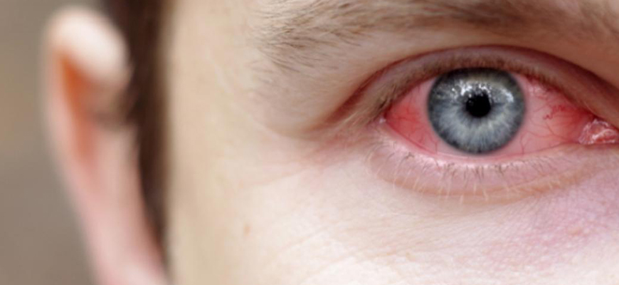 بیماری روماتیسم چشمی علائم عوارض و درمان