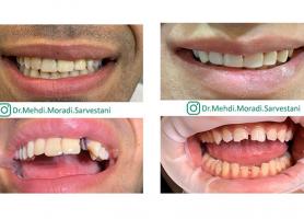 دکتر مهدی مرادی سروستانی - دندانپزشک زیبایی - ایمپلنت