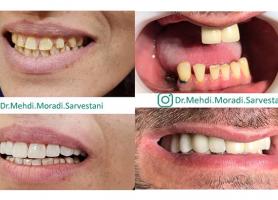 دکتر مهدی مرادی سروستانی - دندانپزشک زیبایی - ایمپلنت