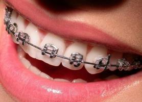 آشنایی با درمان ارتودنسی دندان