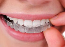 بلیچینگ پرعارضه ترین روش دندانپزشکی