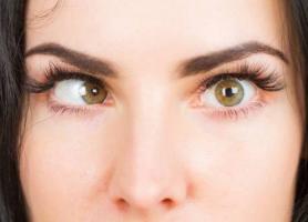 بیماری انحراف چشم یا استرابیسم 