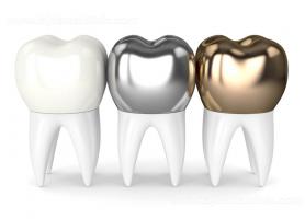 انواع تاج دندان کاربرد مراحل نصب معایب و مراقبت