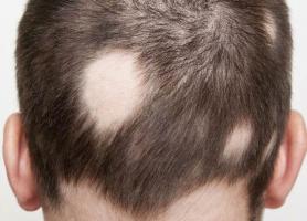 نکات مهم علائم علت و درمان ریزش موی سکه ای