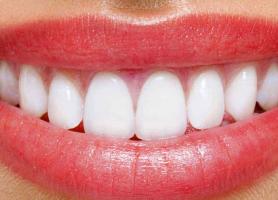 کاربرد مزایا و معایب انواع لامینت دندان