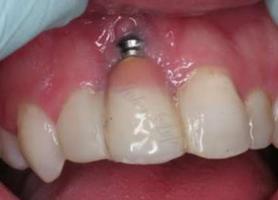 درمان عفونت ایمپلنت دندان