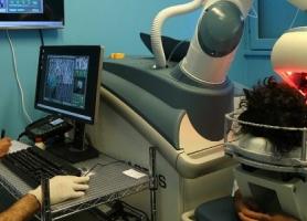 کاشت مو رباتیک با دستگاه آرتاس