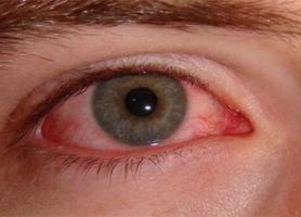 چشم ها چگونه در شیوع کرونا ویروس نقش دارند؟