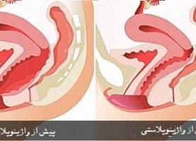 همه چیز درباره واژینوپلاستی
