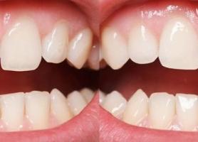 انواع باندینگ دندان مزایا و معایب درمان و مراقبت 