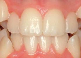 انواع کراودینگ دندان علت درمان اتوردنسی و سوالات متداول