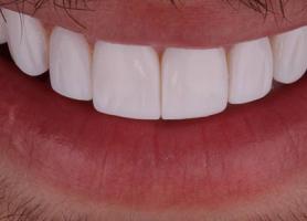 معایب کامپوزیت دندان و مقایسه آن با کامپوزیت ونیر