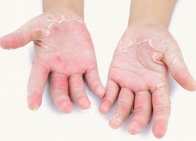 عوامل پوست پوست شدن دست ها