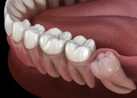 علت بروز درد دندان عقل و درمان آن