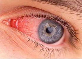 بیماری های حدقه چشم