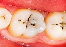 شایع ترین بیماری های دهان و دندان