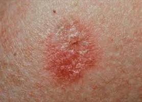 خطرات تهدید کننده ناشی از سرطان پوست