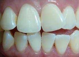 انواع کراودینگ دندان علت درمان اتوردنسی و سوالات متداول