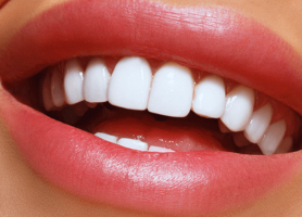 کاربرد مزایا و معایب انواع لامینت دندان