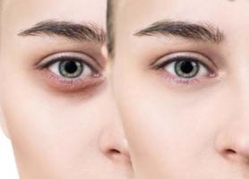 درمان سیاهی یا کبودی زیر چشم