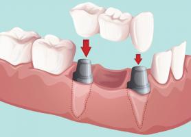 انواع بریج دندان مزایا معایب مواد سازنده و هزینه آن