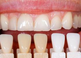 تفاوت کامپوزیت با لمینت دندان