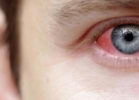 بیماری روماتیسم چشمی علائم عوارض و درمان