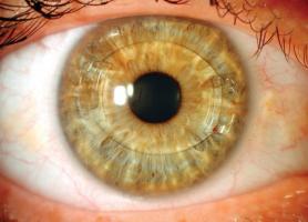 کاربرد لنزهای داخل چشمی