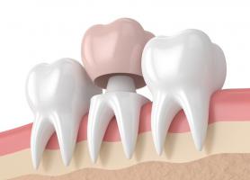 انواع تاج دندان کاربرد مراحل نصب معایب و مراقبت